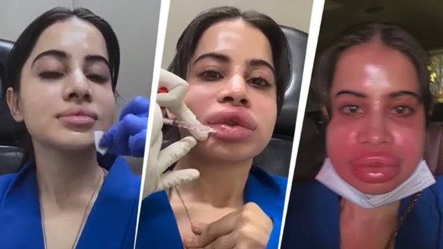 Uorfi Javed gets lip fillers dissolved after 9 years. (Photo Credit: Instagram/ Uorfi Javed)