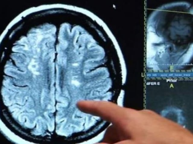 Resonancia magnética cerebro accidente cerebrovascular ACV