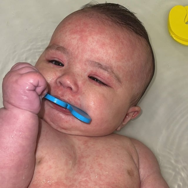Four-month-old Kimie Fukuta-Birch of Fort Saskatchewan, Alta., seen in this undated handout photo, was diagnosed with measles. Her mother, Morgan Birch, says she feared the worst for her daughter. While Kimie has now recovered, Birch says she faces a long road to recovery. THE CANADIAN PRESS/Handout — Morgan Birch (Mandatory Credit)