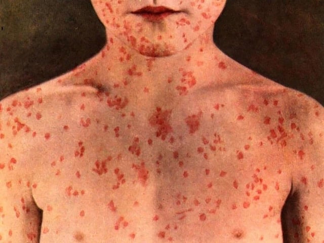 Nova Scotia Public Health confirmed 30 total cases of measles in the Northern Zone on Thursday.