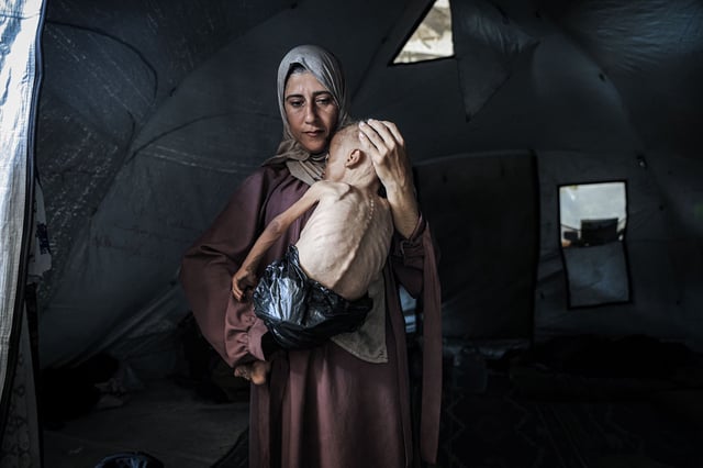 Muhammad Zakariya Ayyoub al-Matouq, a 1.5-year-old child pictured on July 21 in Gaza City, Gaza, faces life-threatening malnutrition due to ongoing Israeli attacks and blockade.