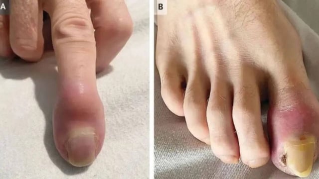 Rare, Weird Swellings in Man's Fingers and Toes Lead to Full-Blown Lung Cancer