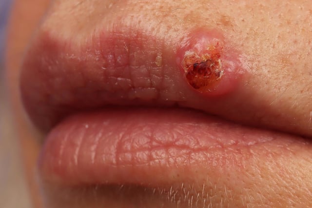 Squamous cell carcinoma of the upper lip in a 50-year-old woman. 