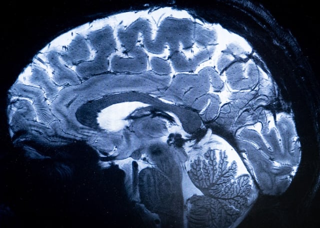 This image made with the Iseult Magneton 11.7 T MRI shows a brain during a magnetic resonance imaging (MRI) exam simulation at the Neurospin facilities in the Paris-Saclay Alternative Energies and Atomic Energy Commission (CEA - Commissariat a l&#39;energie atomique et aux energies alternatives) centre in Gif-sur-Yvette, on March 22, 2024. &#34;Iseult&#34;, the world&#39;s most powerful MRI scanner, has delivered its first images of the human brain and is expected to provide a better understanding of its functioning and of certain neurodegenerative and psychiatric diseases. (Photo by ALAIN JOCARD/AFP via Getty Images)