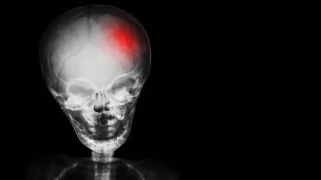 Fit and Healthy Woman Who Thought Headaches Were Stress Given Ultra-Rare Diagnosis