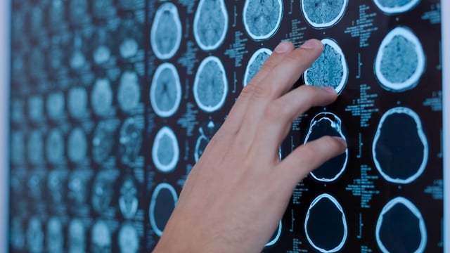 H3 K27M-mutant diffuse midline glioma is a rare and highly aggressive brain tumour. Credit: Dmytro Zinkevych/Shutterstock.com.