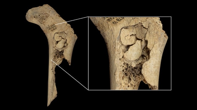 A photograph of an infant human femur with percussion marks for marrow extraction.