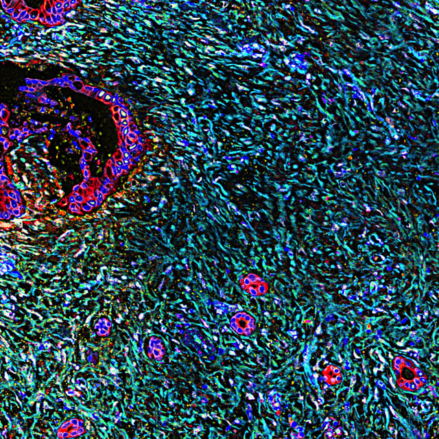NIH Image Gallery National Institutes of Health (NIH) Follow Pancreatic Desmoplasia As shown here, pancreatic cancer is associated with a vast desmoplastic reaction in which the connective tissue around the tumor thickens and scars. Tests similar to the one depicted here help distinguish between "good" and "bad" stromal reactions. Researchers hope this could allow the design of therapies that will reprogram tumor-stromal interaction. Cancerous cells are in red; nuclei are in blue; stroma/desmoplasia is in cyan; and stroma-specific markers are in yellow and green while marker overlays appear white. This image was originally submitted as part of the 2016 NCI Cancer Close Up project and selected for exhibit. See also visualsonline.cancer.gov/closeup2016. Credit :Neelima Shah and Edna Cukierman, Fox Chase Cancer Center, National Cancer Institute, National Institutes of Health https://www.flickr.com/photos/nihgov/26645704270/in/photolist-GAAcyj-GAACEb-VKAEBG-FZk4ue-KFjbez-GXJM1U/