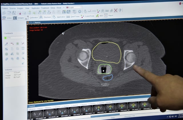 A doctor points at a screen with the tests of a patient suffering from cervical cancer