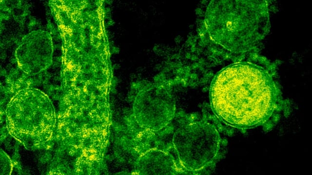 Legionnaires’ disease is a form of pneumonia caused by bacteria that grow in warm water and spread through water systems in buildings. (Representative image)