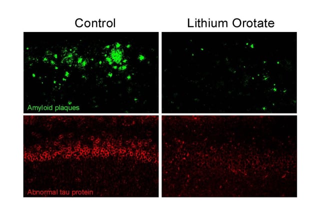 Pathology images from the brain of an Alzheimer’s mouse model. The images show that when the mice are treated with a very low dose of lithium orotate, it almost completely eradicates the amyloid plaques and the tau tanglelike structures. (Harvard)