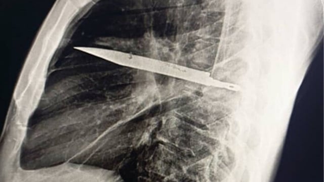 44 year old man had knife stuck in his chest for 8 years without knowing