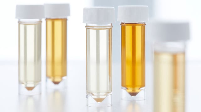 Urine Sample Analysis