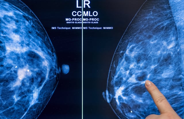 25 February 2022, Berlin: Medical personnel use a mammogram to examine a woman’s breast for breast cancer. Photo: Hannibal Hanschke/dpa (Photo by Michael Hanschke/picture alliance via Getty Images)