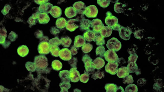 Histopathology of amebic meningoencephalitis due to Naegleria fowleri | Commons/CDC