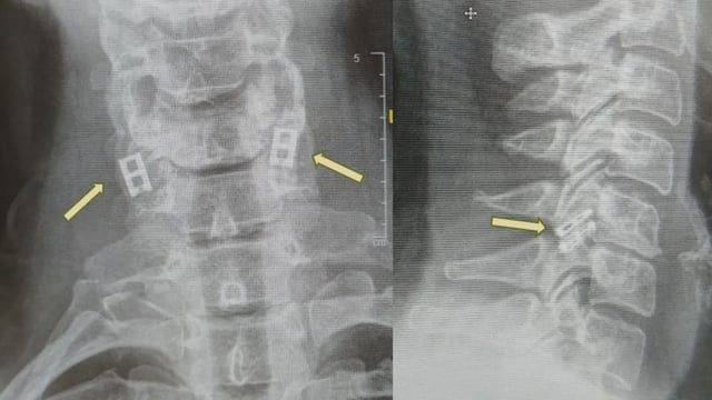 Israel to Perform World’s First Human Spinal Cord Implant