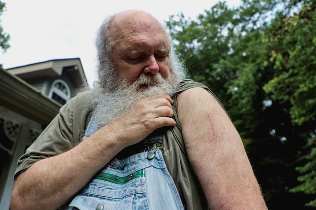 Steve Hicks, a retired nuclear machinist at the Y-12 National Security Complex who says he is now battling skin cancer after years of handling hazardous materials, shows a scar where cancer was removed, outside his rural log cabin in Harriman, Tennessee, U.S., August 8, 2025. REUTERS/Eric Cox