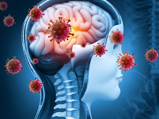 Das Bild veranschaulicht eine virale Meningitis.