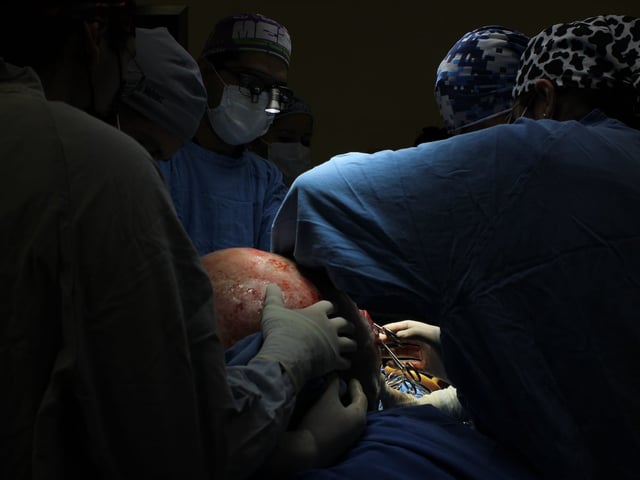 Mujer derechohabiente del IMSS, presentó un tumor de más de 22 kilos, mismo que fue retirado con éxito por especialistas del Seguro Social en Querétaro