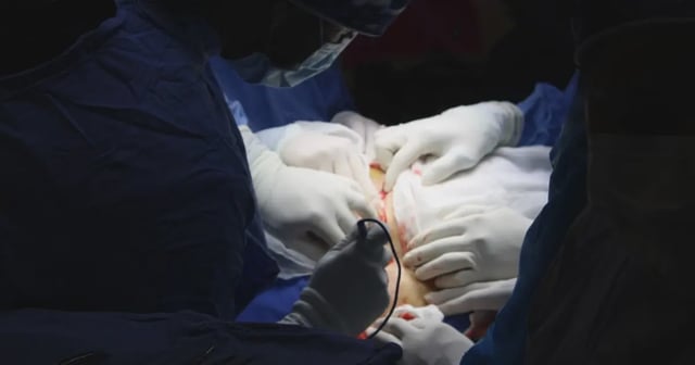 Equipo médico del IMSS durante una cirugía compleja para extraer un tumor ovárico de gran tamaño. La imagen muestra a varios especialistas trabajando de forma coordinada con iluminación focalizada sobre el área abdominal de la paciente, destacando la precisión y profesionalismo del procedimiento quirúrgico.