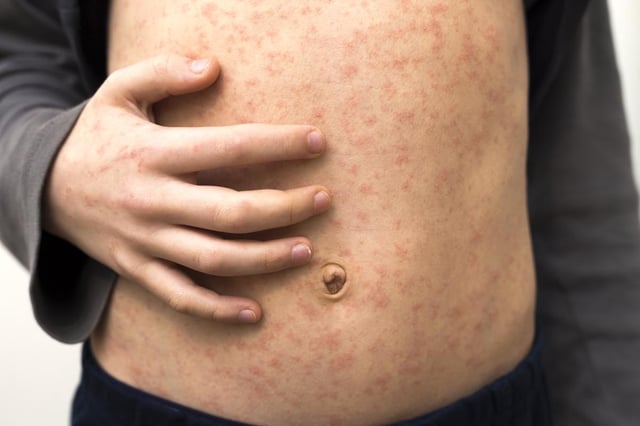 A confirmed case of measles has sparked a fresh health alert after an Australian returned from a popular holiday destination unknowingly infectious. 