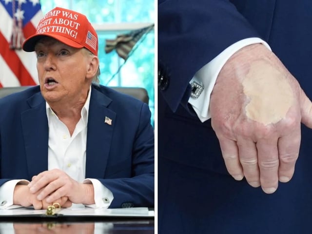 Preocupación en las redes por los moretones y heridas en las manos de Donald Trump. Foto: NDTV