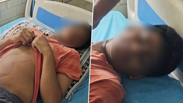 ‘They Threatened to Kill Me’: 16-Year-Old Brutally Ragged, Burnt with Hot Iron Box at Andhra Hostel; Mother Seeks Justice | Image: Republic