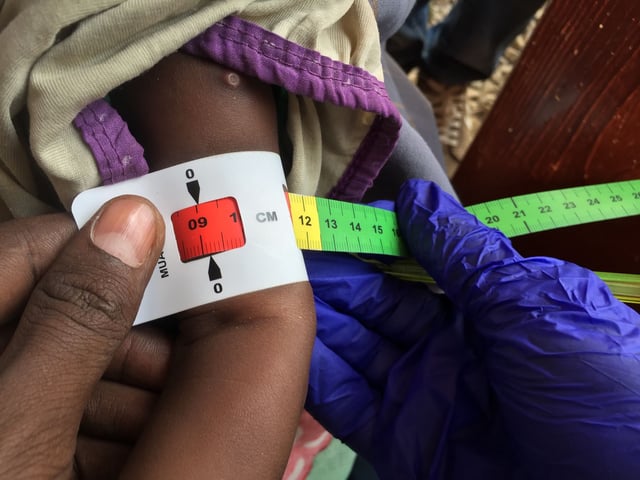 Ein Arzt misst den Armumfang eines unterernährten Babys. Die rote Markierung bedeutet: Das Kind ist schwer unterernährt und braucht dringend Spezialnahrung.
