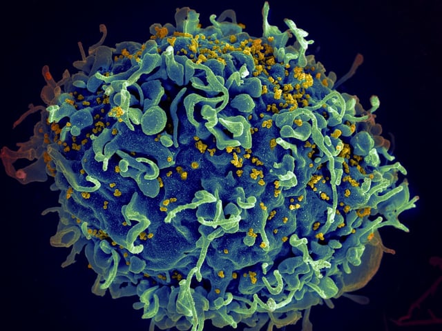 Une image au microscope d'un lymphocyte T attaqué par le VIH.