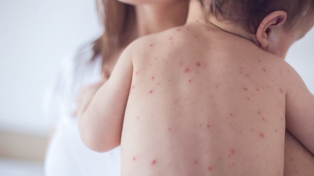 The NHS is following other countries in including the chickenpox jab in routine childhood vaccinations