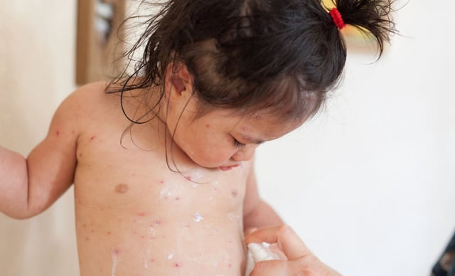 The jab, which currently costs around £150 at private clinics and pharmacies, will form part of a new combined immunisation on the childhood vaccination programme (Photo: BSIP/Getty)