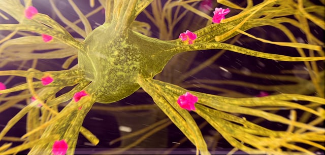 Die Abbildung zeigt Amyloid-Plaques (pink) an Nervenzellen