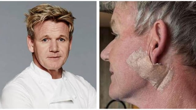 Gordon Ramsay shared that he has been diagnosed with skin cancer.