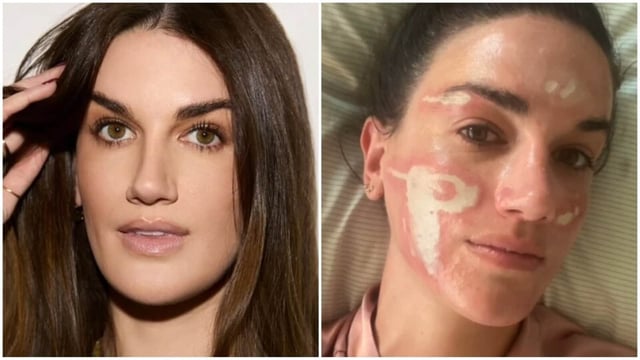 Victoria Nelson has detailed her experience with severe burns that she alleges are due to a chemical peel given by a Beverly Hills celebrity esthetician. (Instagram/ Victoria Nelson)