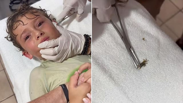 Extrajeron un cangrejo diminuto del oído de una conocida influencer mexicana. Tanto el niño como el animal están a salvo. 
