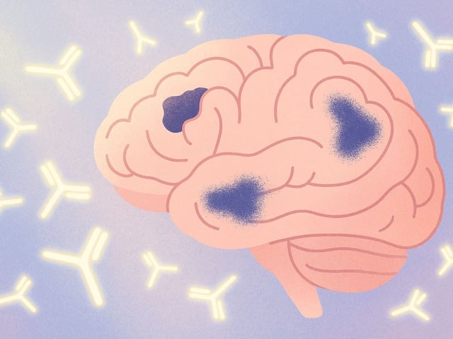 Los medicamentos contra Alzheimer avanzan conforme pasa el tiempo