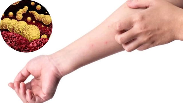 Rare Flesh-Eating Bacteria Kills 5 in Louisiana, Causes, Symptoms, Risks, and Prevention Explained