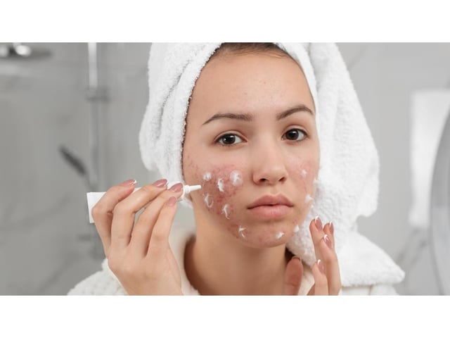 Una crema para el acné es uno de los productos prohibidos por la ANMAT (Imagen ilustrativa).