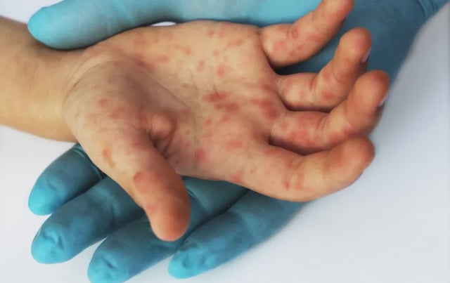 6th Child Passes Away From Measles Complications, 7 More In Intensive Care