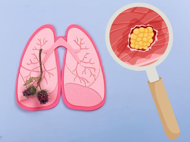 Cáncer de pulmón en no fumadores va en incremento Foto Canva