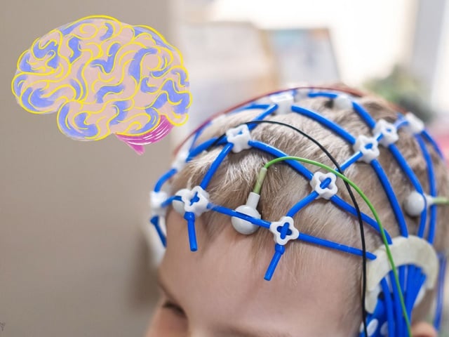 IA ayuda a localizar lesiones cerebrales en niños con epilepsia Foto Canva