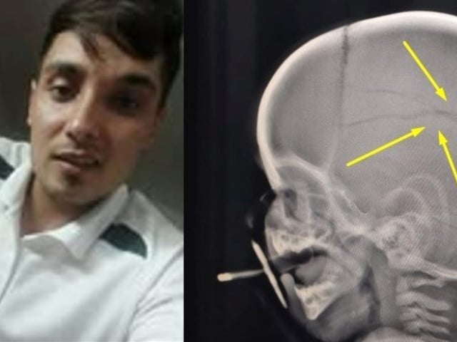 Maximiliano Roth (23), detenido otra vez por fracturarle el cráneo a un bebé de 11 meses en Coronel Suárez. La radiografía con las lesiones.