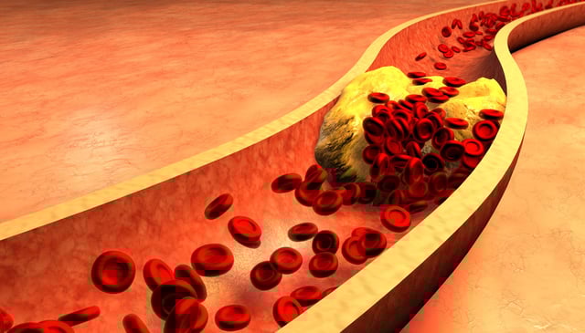 HDL, LDL, heart disease, cholesterol, stock