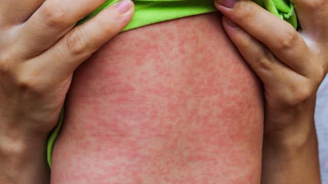 Alberta has recorded its first confirmed measles death since the outbreaks began in March. Since then 1,914 cases have been reported in the province.