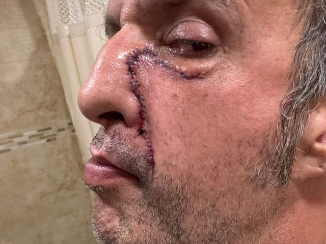 Tito Fuentes muestra las marcas en su rostro tras años de excesos y cirugías