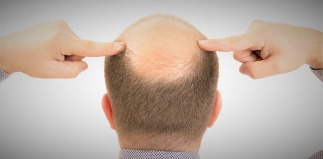 Calvicie o alopecia