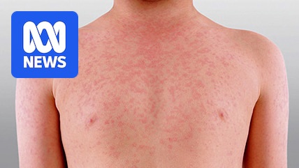 A stock photo of a boy infected with measles.
