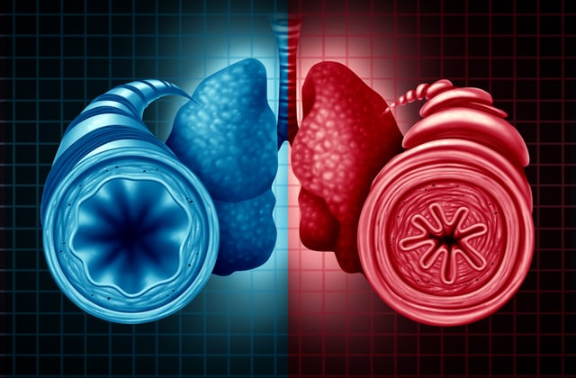 Asthma health diagnosis as a diagram with a healthy and unhealthy bronchial tube with a constricted breathing problem caused by respiratory muscle tightening with 3D illustration elements.