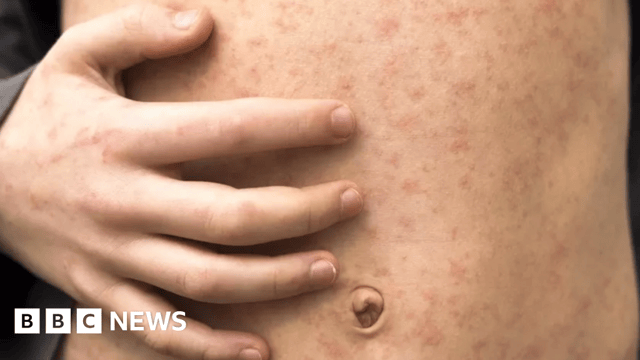 A person with measles