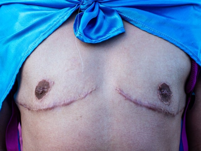 A demonstrator marches with their gender change scars during the 'Yo Marcho Trans' annual transgender communities pride parade in Bogota, Colombia, July 7, 2023. (Photo by Sebastian Barros/NurPhoto via Getty Images)